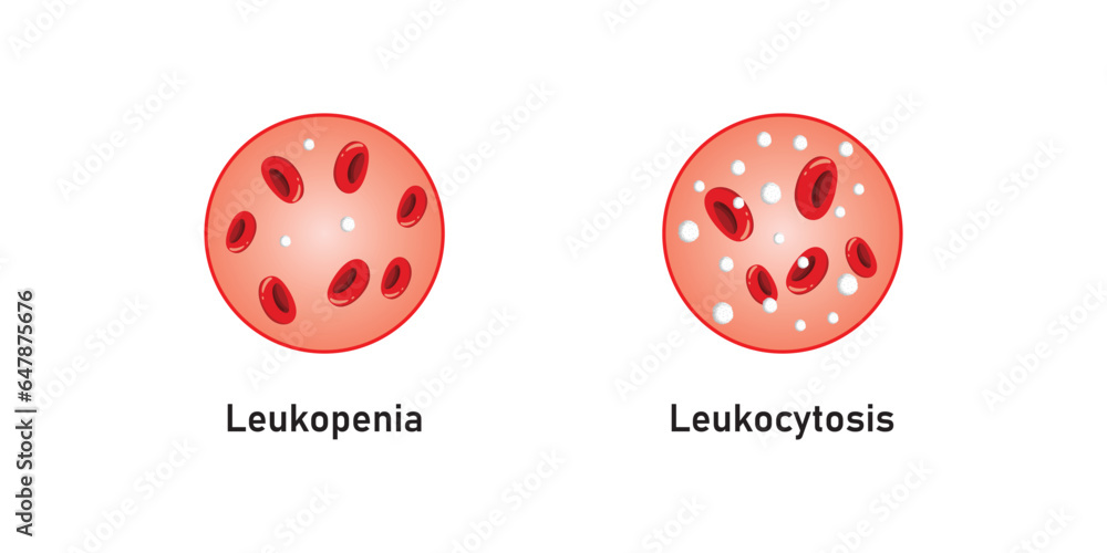 Leukopenia and Leukocytosis Concept Design. Vector Illustration. Leukopenia and Leukocytosis Concept Design. Vector Illustration.