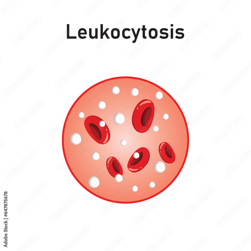 Leukocytosis Concept Design. Vector Illustration. Leukocytosis Concept Design. Vector Illustration.