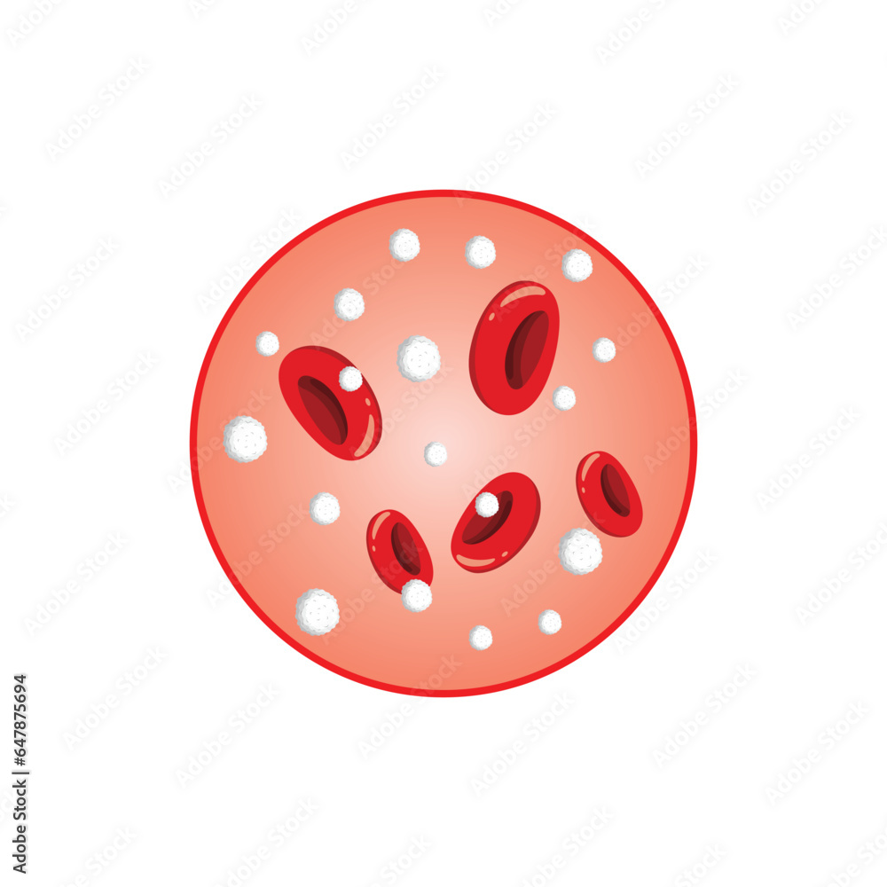 Leukocytosis Concept Design. Vector Illustration. Leukocytosis Concept Design. Vector Illustration.
