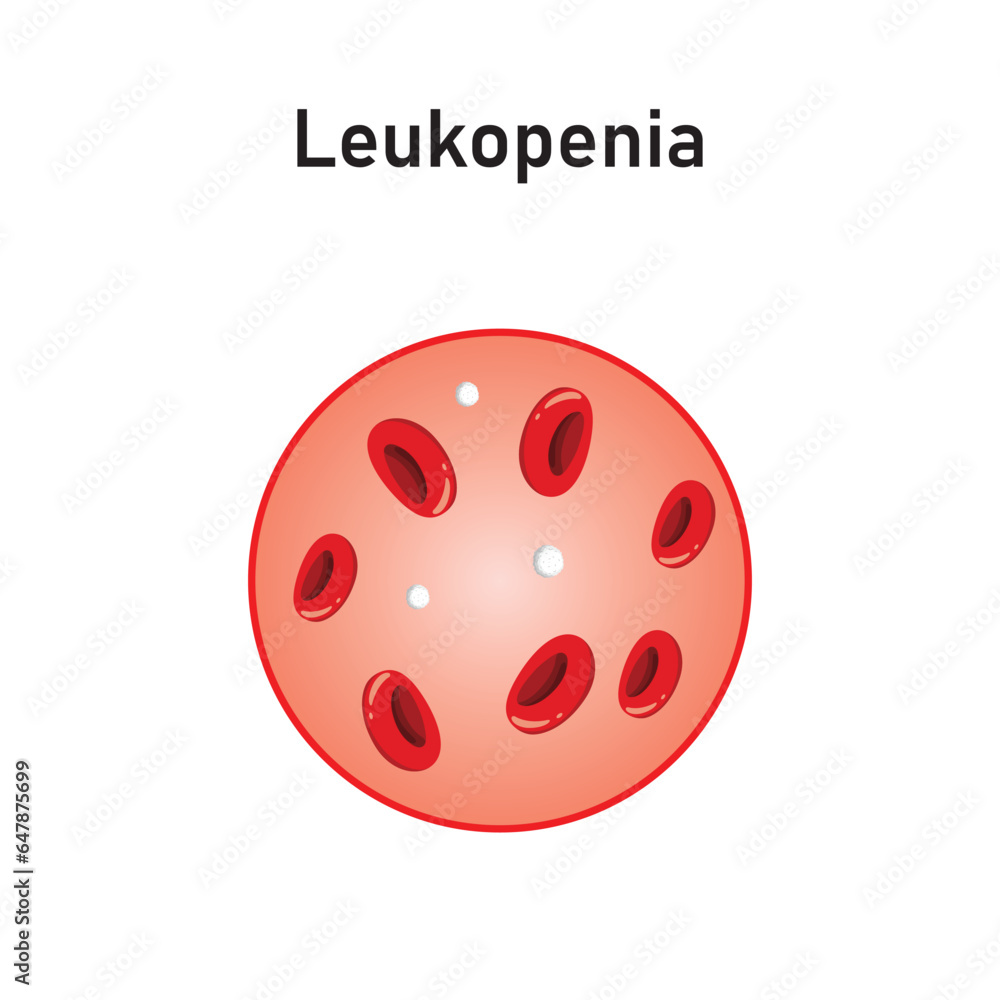 Leukopenia Concept Design. Vector Illustration. Leukopenia Concept Design. Vector Illustration.