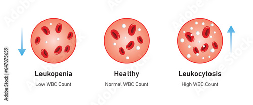 Leukopenia and Leukocytosis Concept Design. Vector Illustration.