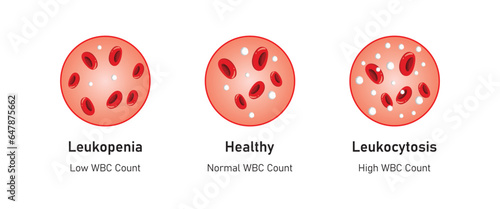 Leukopenia and Leukocytosis Concept Design. Vector Illustration.