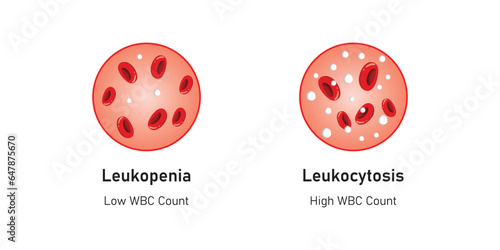 Leukopenia and Leukocytosis Concept Design. Vector Illustration.