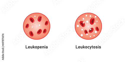 Leukopenia and Leukocytosis Concept Design. Vector Illustration.