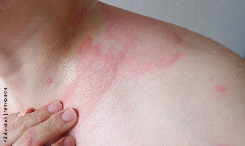 Fototapeta premium Close up image of skin texture suffering severe urticaria or hives or kaligata. Allergy symptoms.