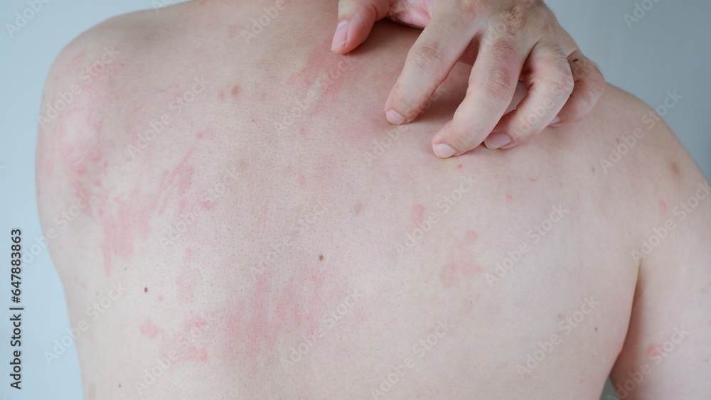 Fototapeta premium Close up image of skin texture suffering severe urticaria or hives or kaligata. Allergy symptoms.