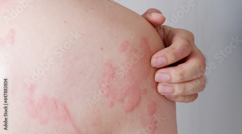 Close up image of skin texture suffering severe urticaria or hives or kaligata. Allergy symptoms.