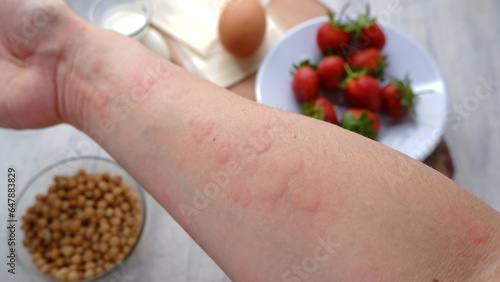 Fotografie Close up image of arm suffering severe urticaria or hives or kaligata with illustration of allergy trigger foods