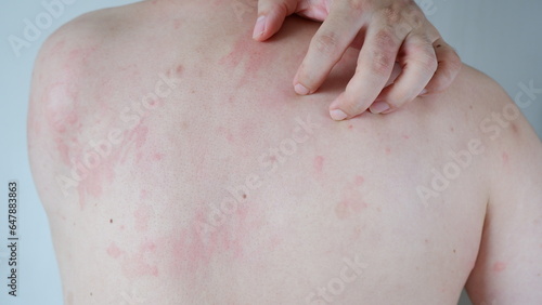 Close up image of skin texture suffering severe urticaria or hives or kaligata. Allergy symptoms.