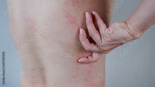 Close up image of skin texture suffering severe urticaria or hives or kaligata on back. Allergy symptoms. photo