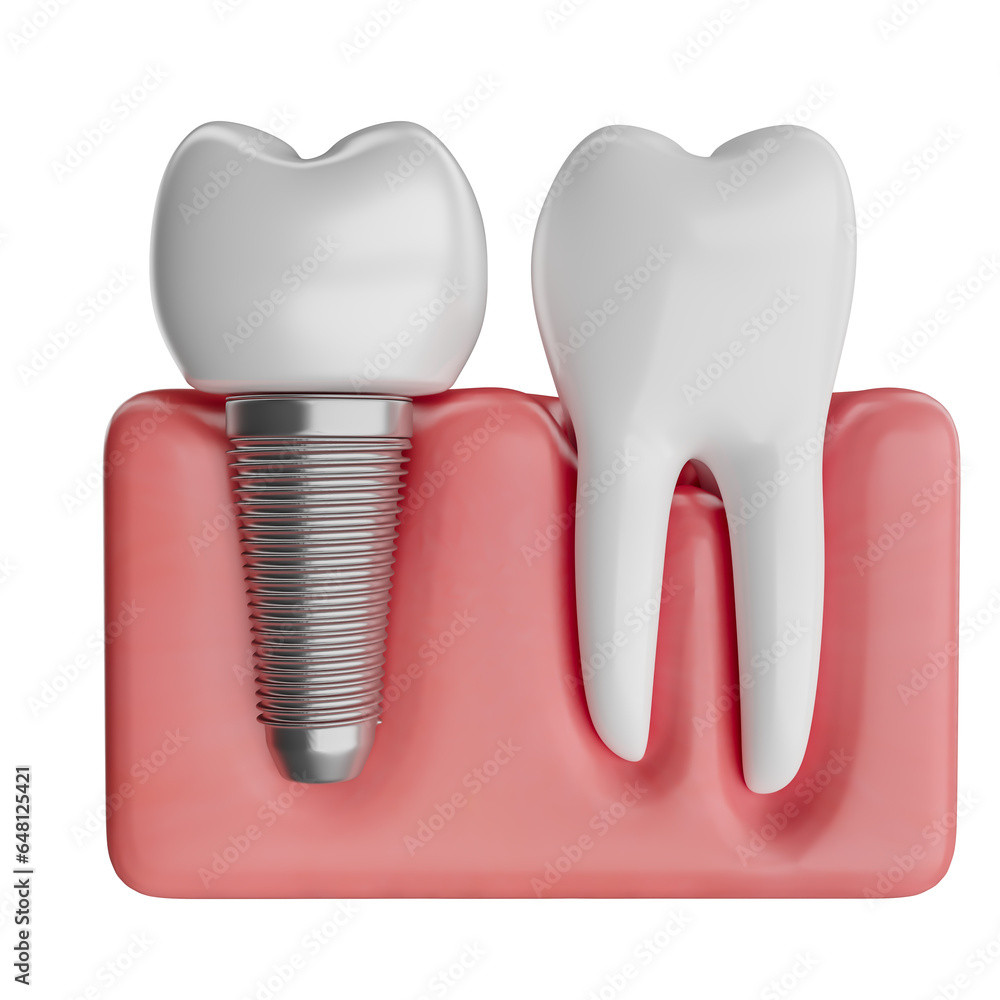 Realistic teeth in gum with implant on transparent background in 3d ...