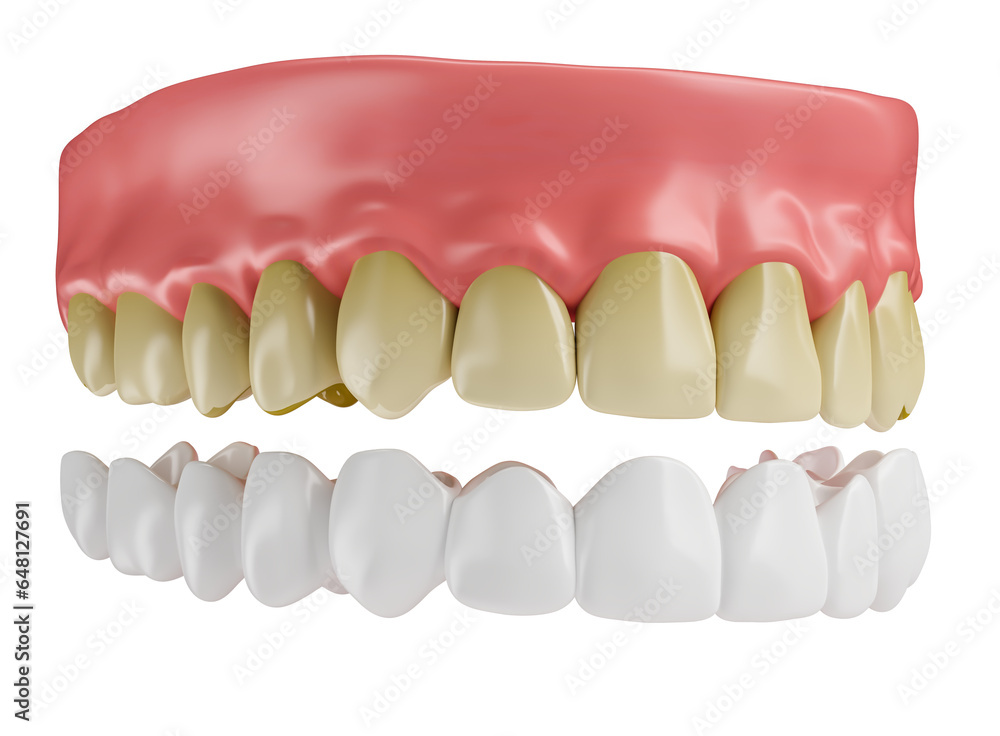 Realistic teeth with lenses and gums in on transparent background in 3d ...