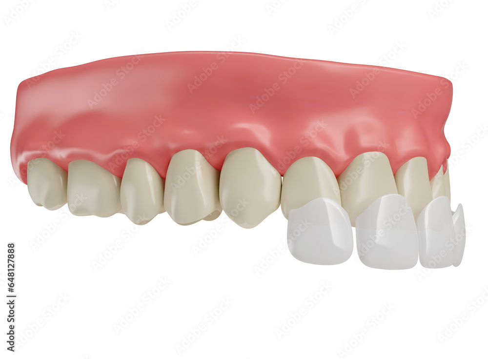 Realistic teeth with lenses and gums in on transparent background in 3d