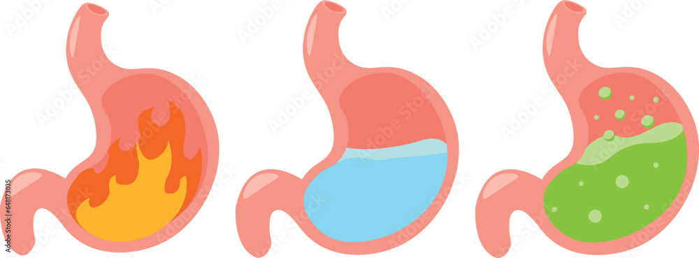 illustration of the stomach in different states. Cartoon visual illustration showing what the stomach looks like and what it can feel under various conditions. Heartburn, cysts