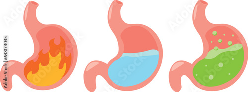 illustration of the stomach in different states. Cartoon visual illustration showing what the stomach looks like and what it can feel under various conditions. Heartburn, cysts