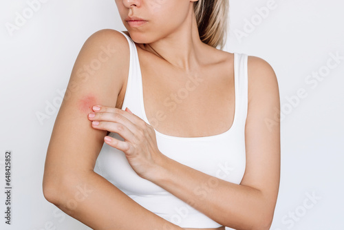 Worried young woman touching an insect bite on her arm isolated on white background. A red rash caused by allergy, inflammatory process. Eczema, atopic dermatitis, lichen, allergy, itching, psoriasis