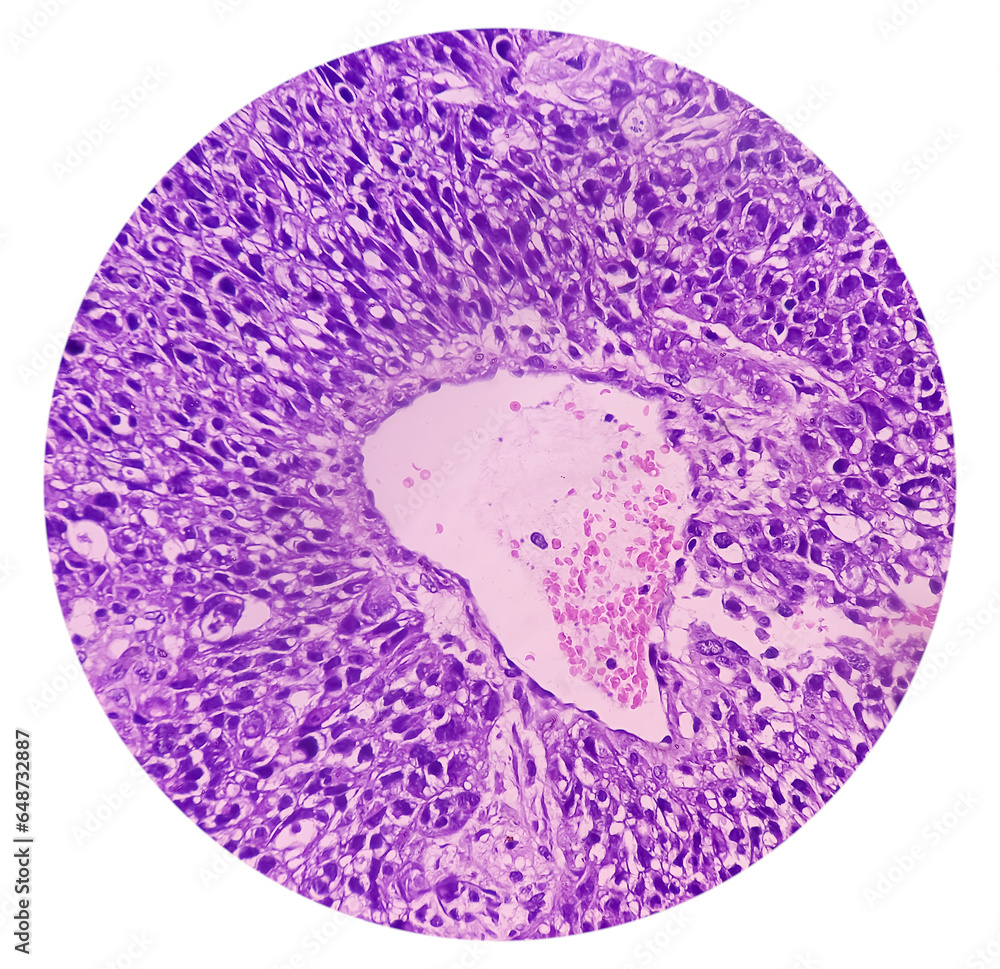 Kidney cancer: Microscopic image of metastatic clear cell carcinoma of ...