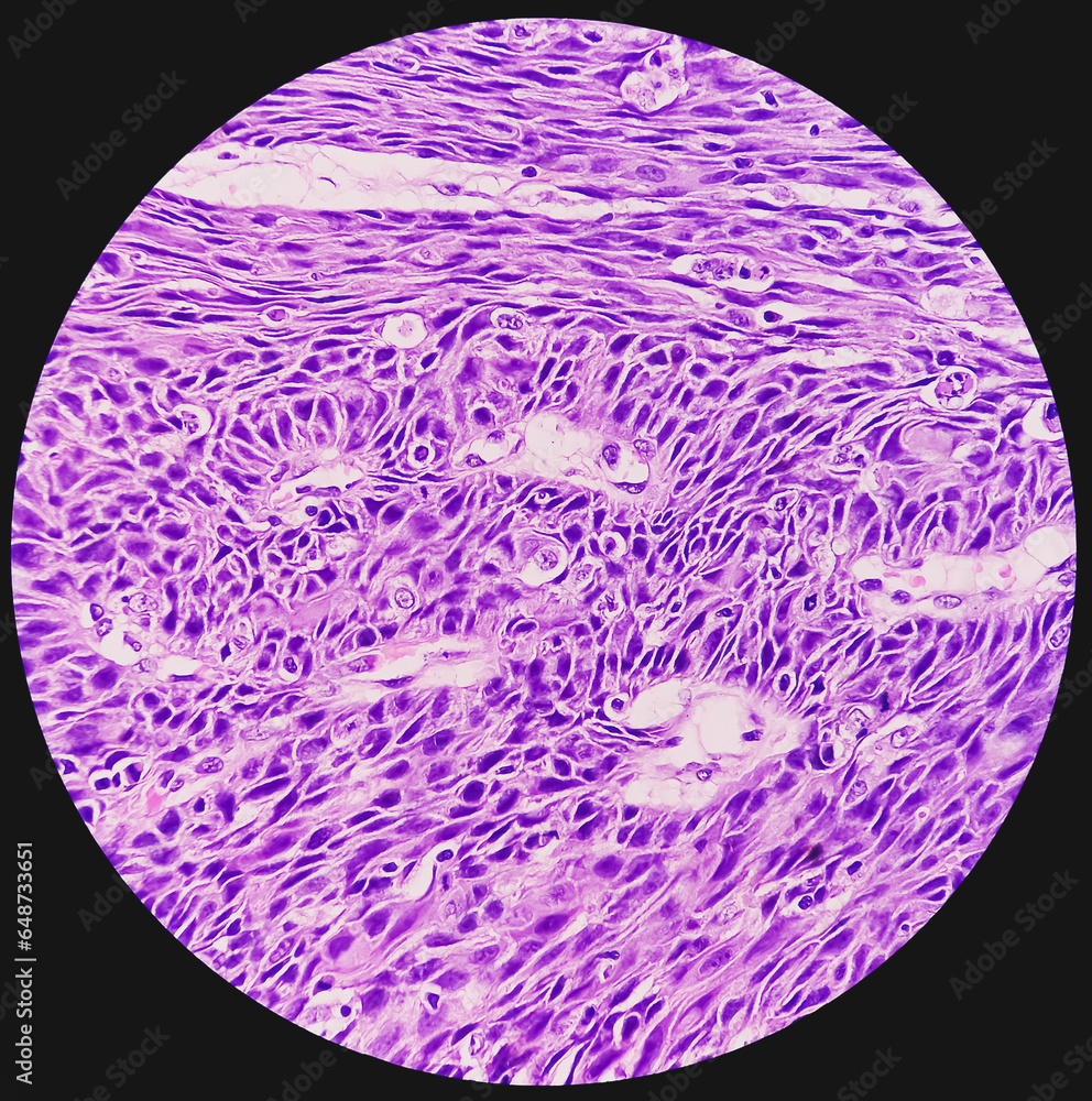 Photomicrograph of Rectal cancer. IBD. IBS. Squamous cell carcinoma of ...