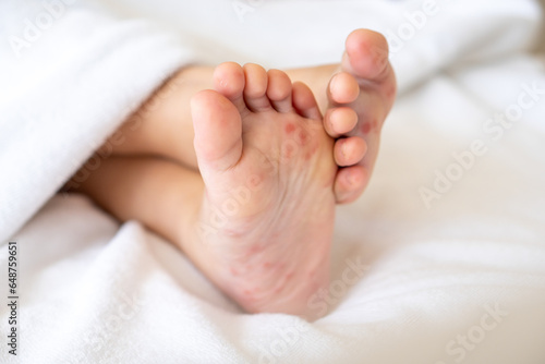 Enterovirus foot red spots blisters on the skin of on the body of a child virus on bed at hospital