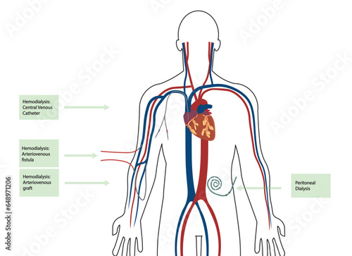 Different types of dialysis illustration. Man body illustration with all types of catheter for hemodialysis 