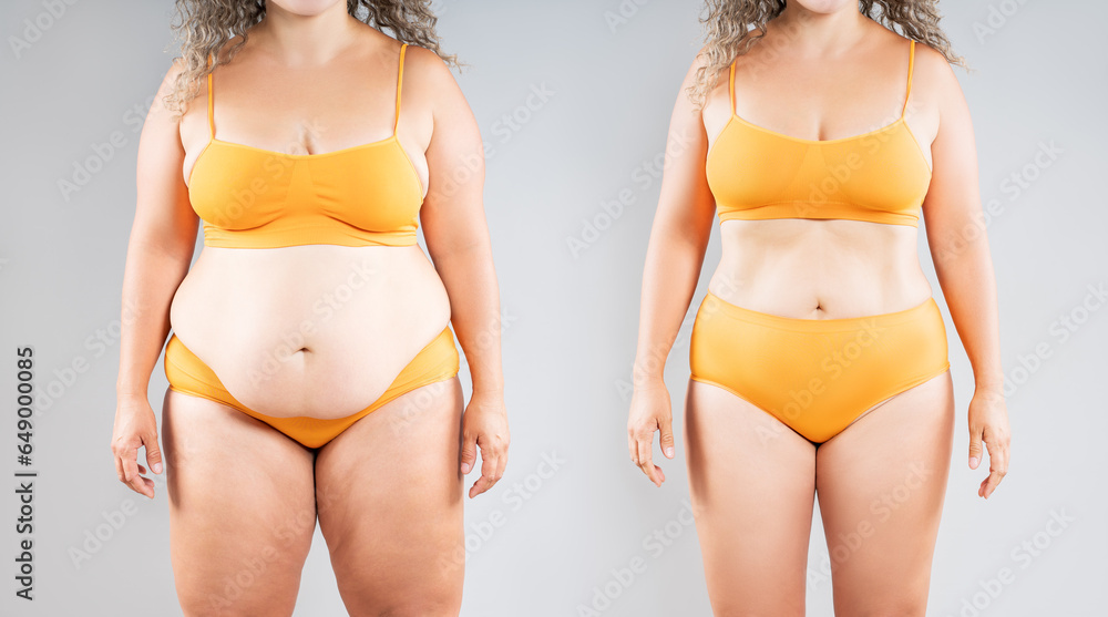 Tummy tuck, woman's fat body before and after weight loss and liposuction on gray background, plastic surgery concept - obrazy, fototapety, plakaty 