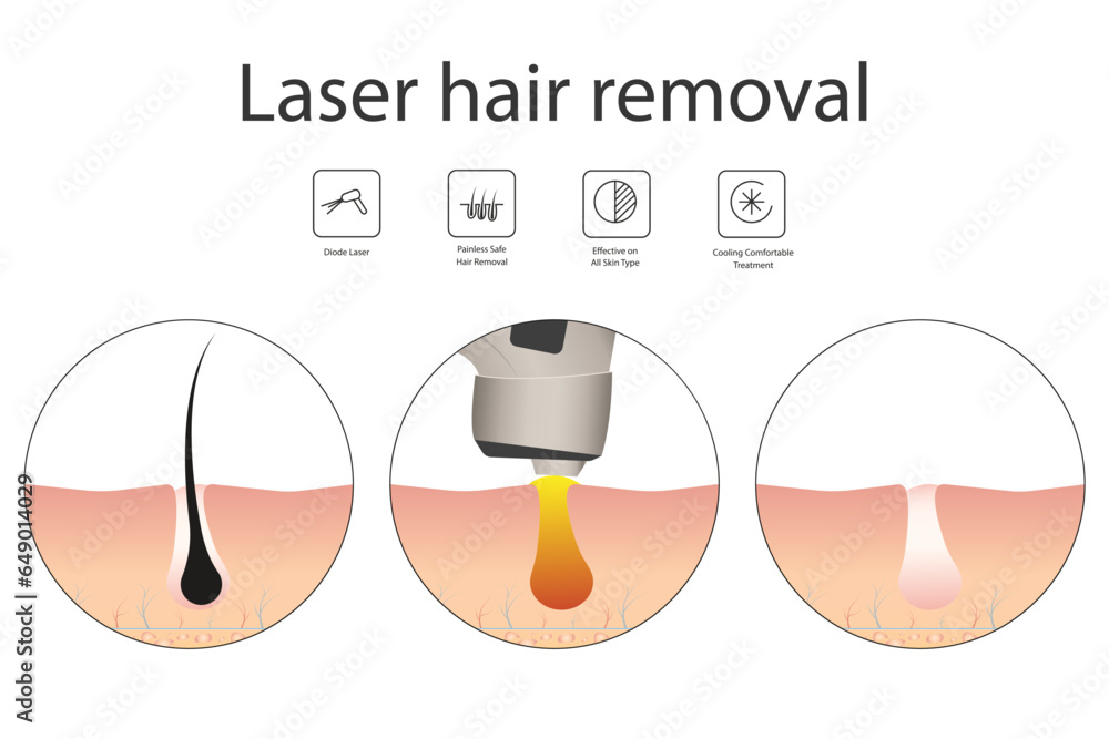 Laser hair removal concept with skin and hair areas. Stages of the