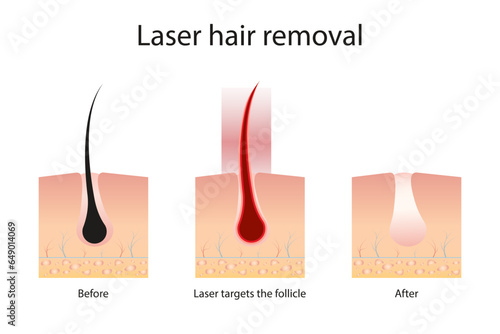 Laser hair removal concept with skin and hair areas. Stages of the removal procedure. Medical diagram before and after using a laser. Vector illustration