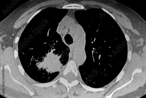 Cat Scan of frontal upper right lobe lung tumor. Medical themes