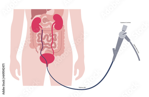 Ureteroscopy medical poster