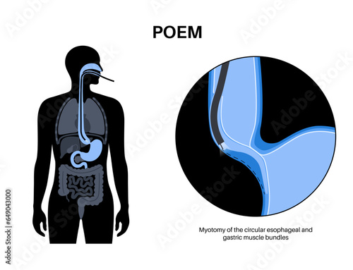 POEM medical poster