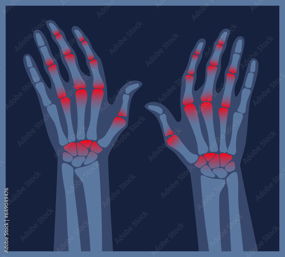 Arthritis hands xray. Pain in the human body. Arthritis, bone disease