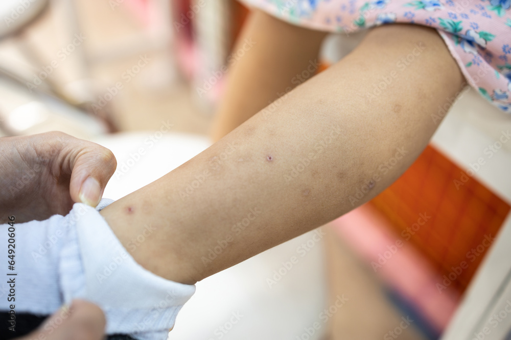 Little child girl with a scars,dark spots on leg from mosquito allergy, infection of an insect