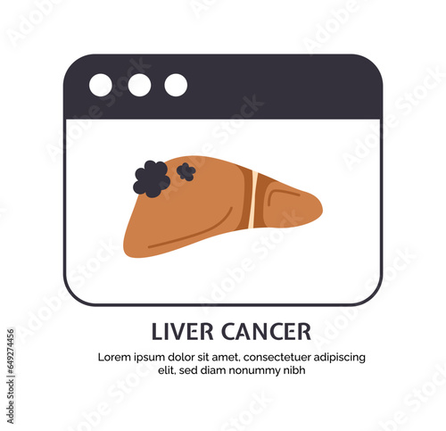 Type of cancer liver concept. Disease of iternal organ. Healthcare and medicine. Medical infographic and educational material. Cartoon flat vector illustration isolated on white background photo