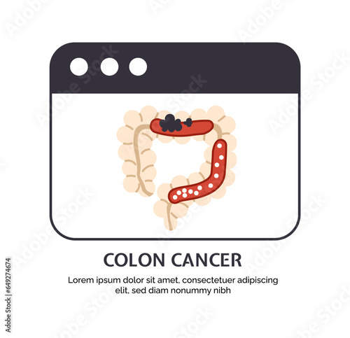 Type of cancer colon concept. Disease of iternal organ. Illness of digestive system. Graphic element for website. Cartoon flat vector illustration isolated on white background