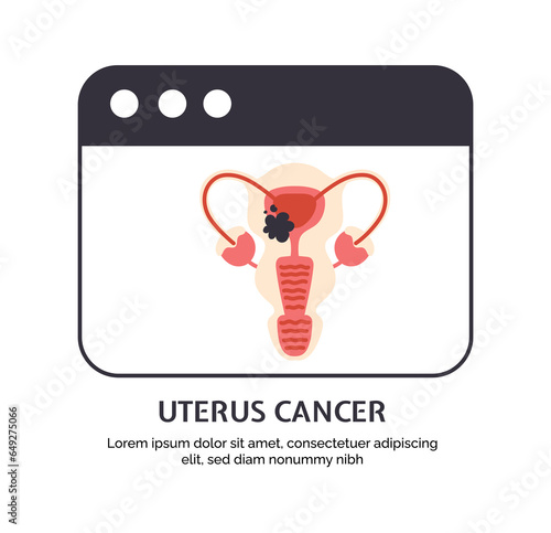 Type of cancer uterus concept. Disease of iternal organ. Illness of reproductive system. Graphic element for website. Cartoon flat vector illustration isolated on white background