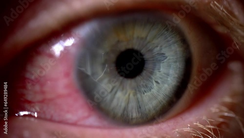 Bloodshot Eye Caused by Ophthalmia Inflammation Sore Exhausted Eyeball