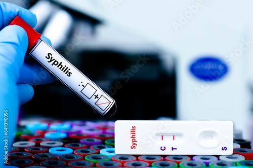Quadro su tela The patient positive tested for syphilis by rapid diagnostic test