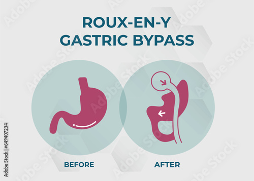  Gastric Bypass RNY Weight Loss Surgery vector illustration icon Roux-en-Y
