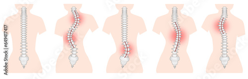 側湾症の背骨のシンプルなイラスト photo