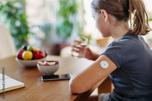 Quadro su tela Close up of continuous glucose monitor sensor on girl's arm.