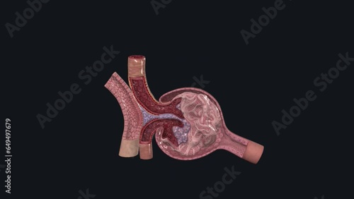 A renal corpuscle (or Malpighian body) is the blood-filtering component of the nephron of the kidney photo