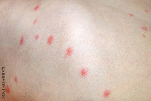 Varicella virus or Chickenpox bubble rash on child photo