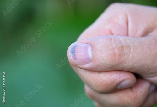 Large hematoma under the nail. Damage to the nail plate of a finger.