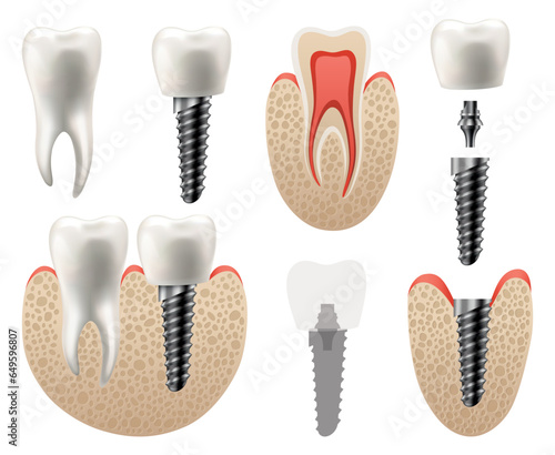 Dental implant structure. Medical educative infographic poster. Teeth implant, realistic vector design of dentistry. Implant screw, healthcare, dentist and orthodontist treatment