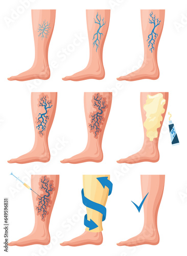Stages or types of varicose veins development. Medical poster or disease infographic. Image of healthy and diseased legs. Vector illustration in flat style