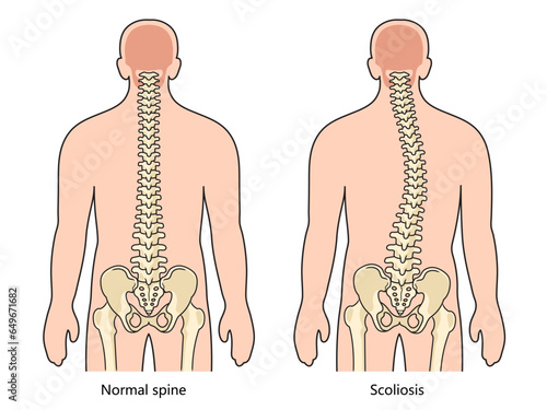 scoliosis structure scheme diagram schematic vector illustration. Medical science educational illustration