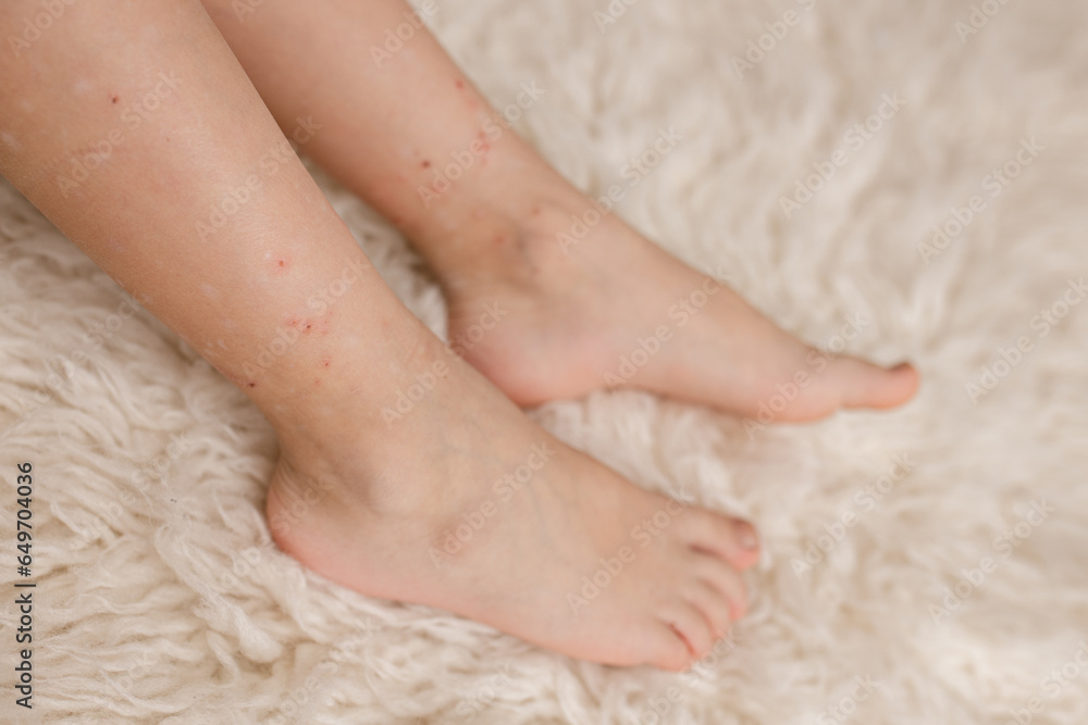 Child's legs with many red spot, from insect bite, mosquitos and fleas Child's legs with many red spot, from insect bite, mosquitos and fleas