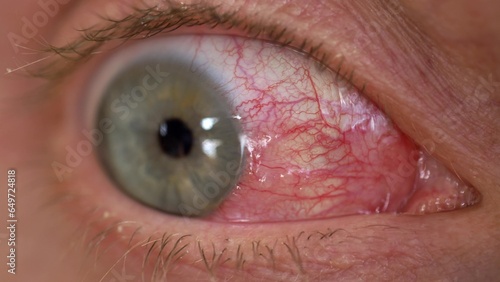Bloodshot Eye Caused by Ophthalmia Inflammation Sore Exhausted Eyeball