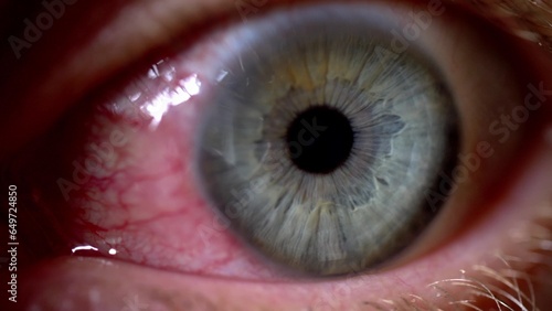 Bloodshot Eye Caused by Ophthalmia Inflammation Sore Exhausted Eyeball