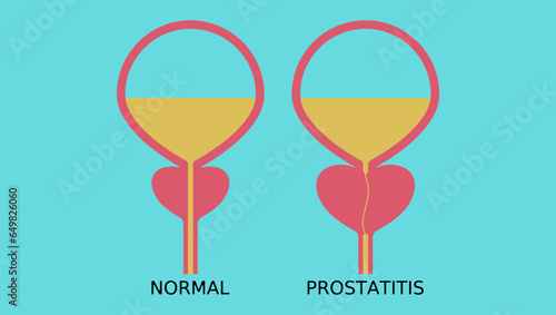 healthy prostate and prostatitis